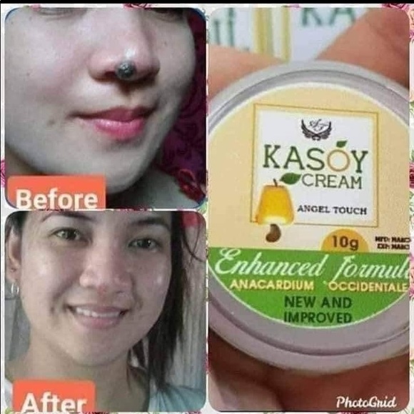 Kasoy Cream by Angel Touch skin tag keloid milia - Picture 9 of 9